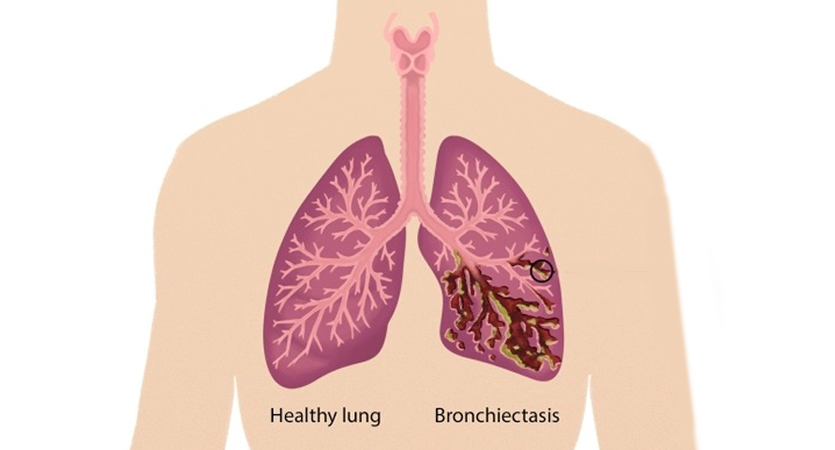 Bronchiectasis treatment in Delhi by Dr. Arvind Kumar